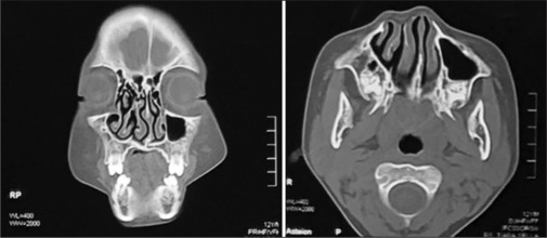Nasal reconstruction of functional supernumerary nostril in a pediatric patient: A rare case.
