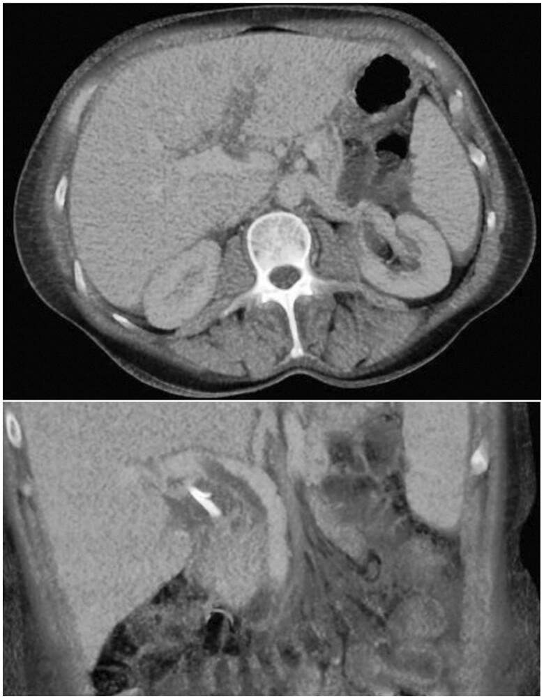 Rare complications of ERCP-pancreatitis, panniculitis, and polyarthritis syndromeand multifocal osteomyelitis.