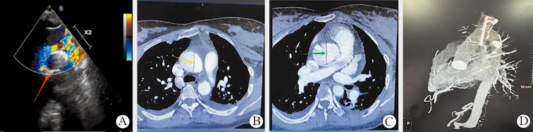 Aortic Dissection Postpartum Without Common Risk Factors Except Pregnancy.