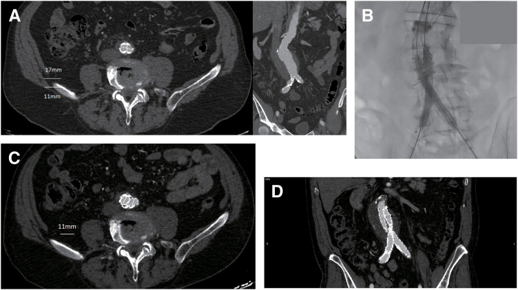 Comparative Study of Endovascular Aneurysm Repair in Patients with Narrow Aortic Bifurcation Using the Unibody AFX2 vs the Bifurcated ALTO Endoluminal System.