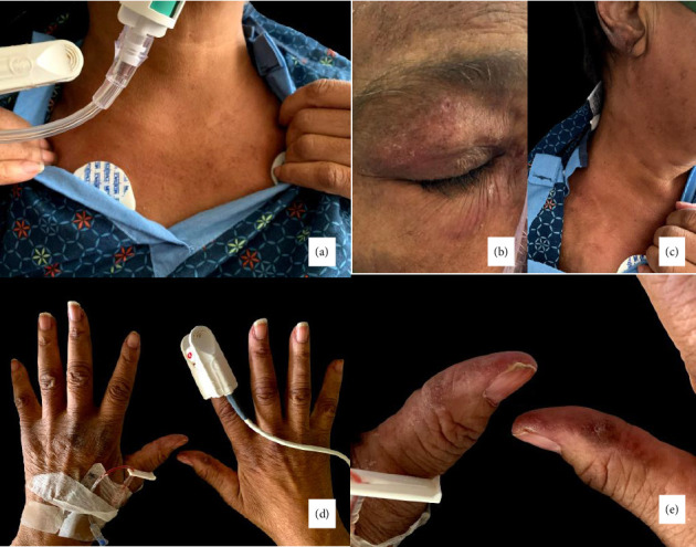 Subcutaneous Emphysema and Severe Interstitial Lung Disease in the Setting of Anti-MDA 5 Positive Dermatomyositis in a Hispanic Patient.
