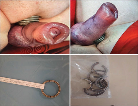 Management of Penile Strangulation by Multiple Metallic Rings: Innovation at a Time of Tribulation.