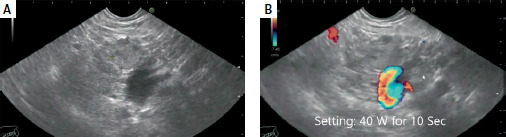 Endoscopic ultrasound-guided radiofrequency ablation (EUS-RFA) and endoscopic ultrasound-guided ethanol ablation (EUS-EA) of pancreatic neuroendocrine tumors and adenocarcinoma: a prospective multicenter study.