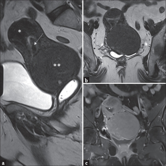 Silent Intruders: A Case Report of Concurrent Atypical Endometrial Polyp with Cervical Intraepithelial Neoplasia.