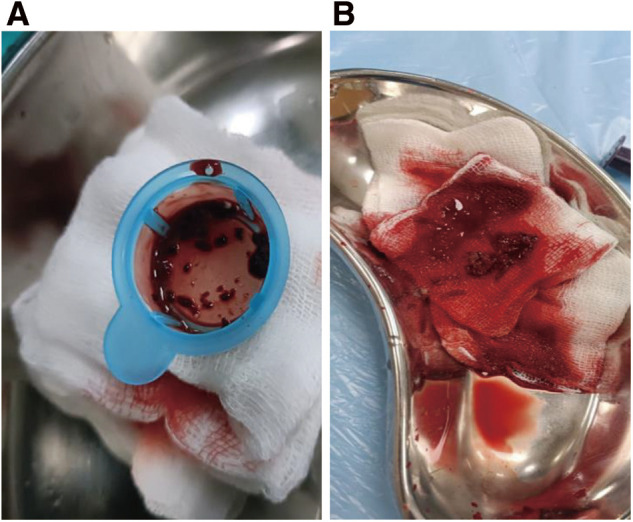 Endovascular Therapy as an Emerging Paradigm for the Treatment of Popliteal Artery Thrombosis Following Total Knee Arthroplasty: A New Approach to Acute Limb Ischemia Management.