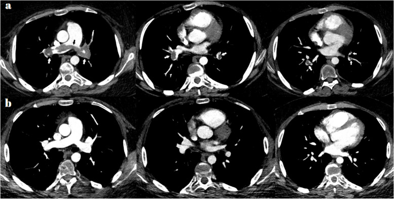Massive pulmonary thromboembolism in a pediatric patient with eosinophilic granulomatosis with polyangiitis: a case-based review emphasizing management.