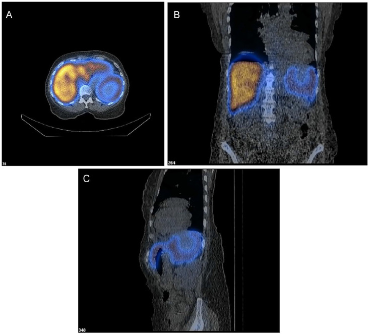 Application of Nuclear Medicine Liver-Spleen Scan for Evaluation of Littoral Cell Angioma of the Spleen: A Case Report.