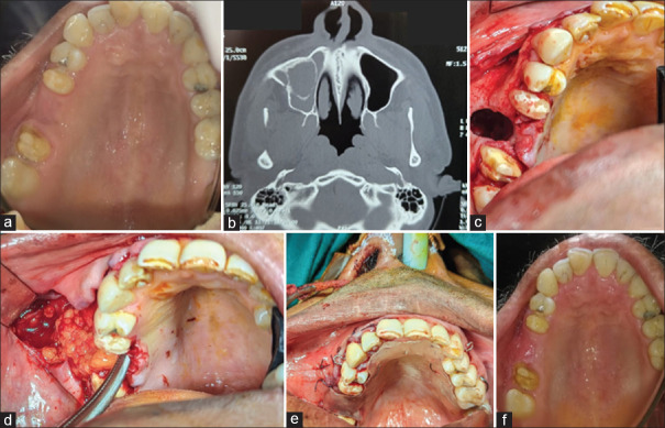 Oroantral Fistula Management in Diabetic Patients - A Case Report.