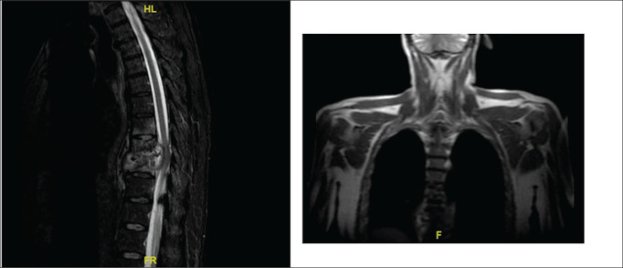 Exploring Thoracolumbar Pott's Disease in the Immunocompetent; Institutional Experience Over a Decade and Comprehensive Literature Review.