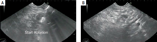 Endoscopic ultrasound-guided radiofrequency ablation (EUS-RFA) and endoscopic ultrasound-guided ethanol ablation (EUS-EA) of pancreatic neuroendocrine tumors and adenocarcinoma: a prospective multicenter study.