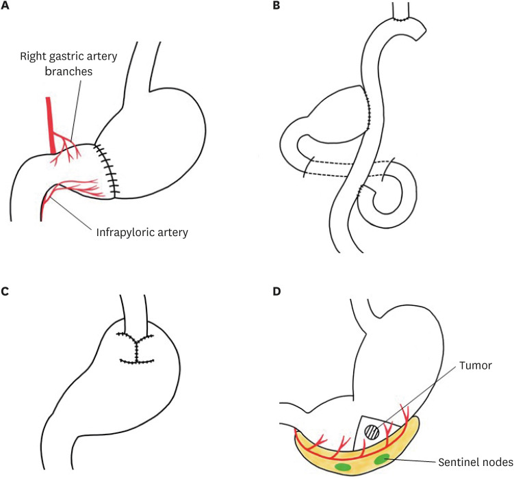 Function Preserving Gastrectomy and Quality of Life.