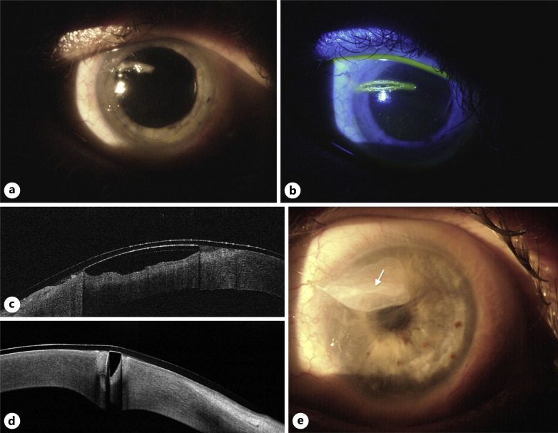 Management of Diathermy-Induced Corneal Burn following Upper Eyelid Blepharoplasty with Multilayer Amniotic Membrane Transplantation: A Case Report and Review of the Literature.
