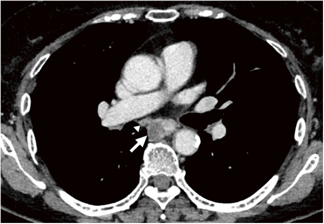 Intraoperative Fluorescent Imaging with Indocyanine Green during Thoracoscopic Esophagectomy with Subcarinal Lymph Node Dissection for Esophageal Cancer with a Right Superior Pulmonary Vein Anomaly: A Case Report and Literature Review.