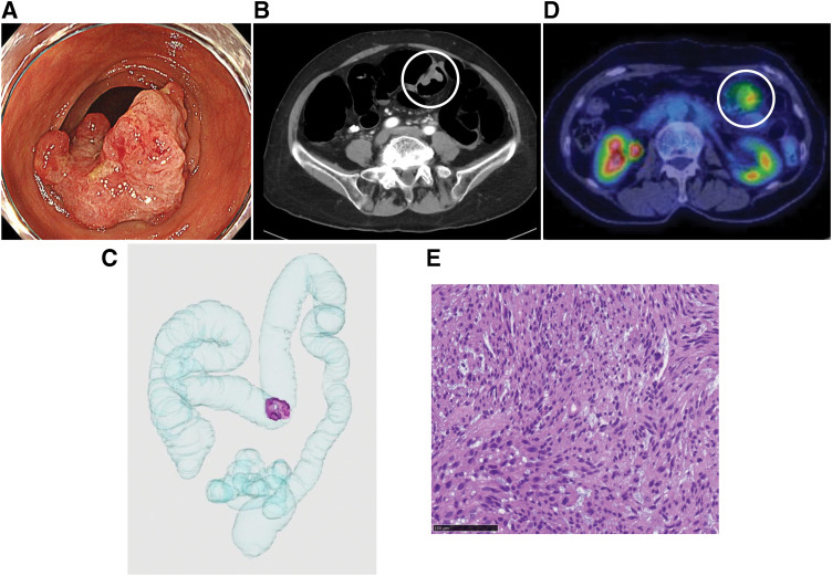A Case of Colon Leiomyosarcoma Arising from the Muscularis Mucosae: A Case Report and Literature Review.