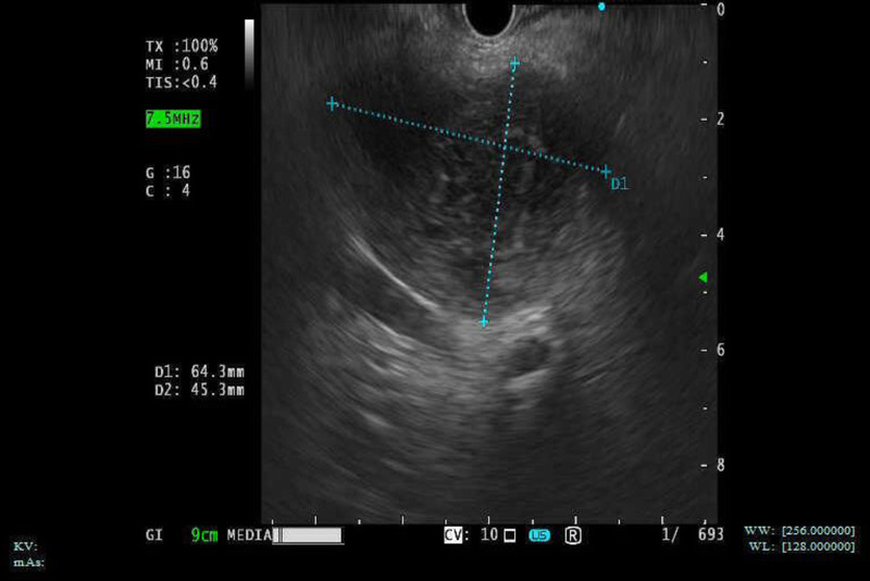 EUS-guided drainage of multidrug-resistant enterococcal caudate lobe abscess inaccessible with percutaneous approach (with video).