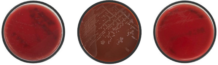 First case report of disseminated gonococcal arthritis in Newfoundland and Labrador.