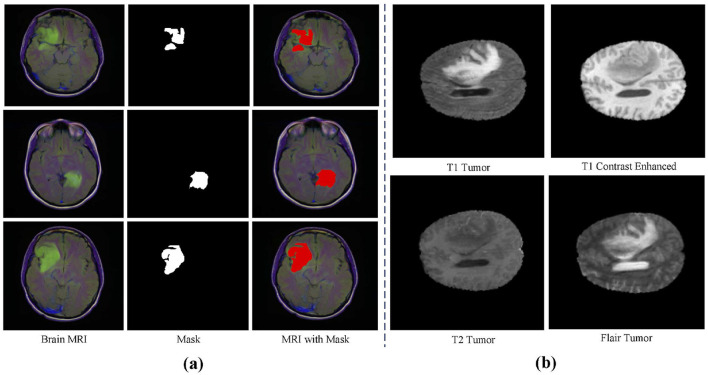 MUNet: a novel framework for accurate brain tumor segmentation combining UNet and mamba networks.