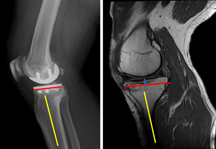Relationship between the location of the popliteal artery and the tibial osteotomy plane in patients with medial and lateral unicompartmental knee arthroplasty: A retrospective analysis of preoperative magnetic resonance imaging and intraoperative findings.