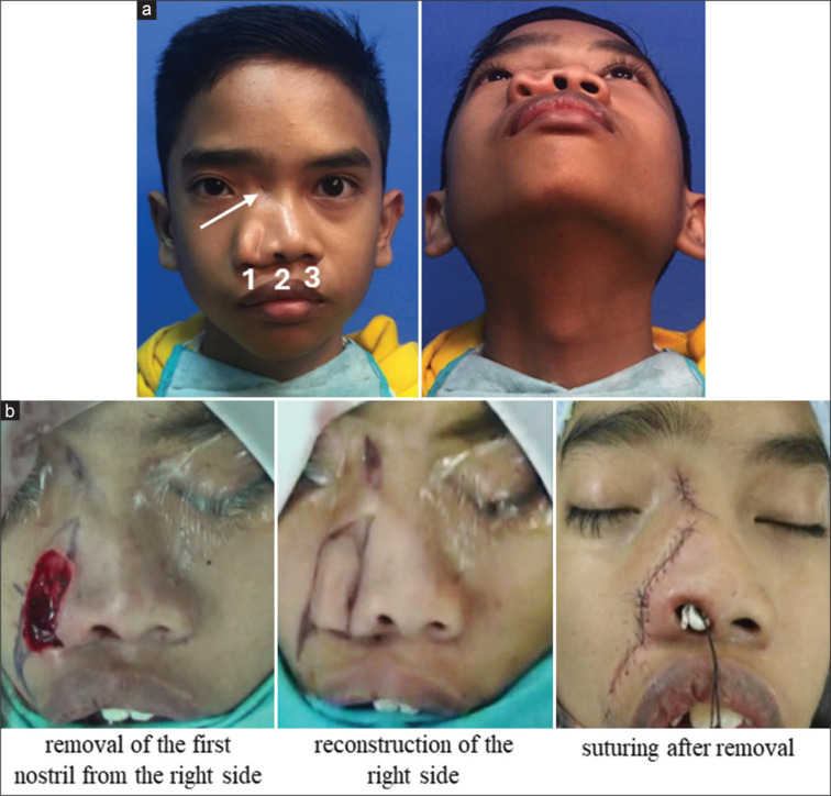 Nasal reconstruction of functional supernumerary nostril in a pediatric patient: A rare case.