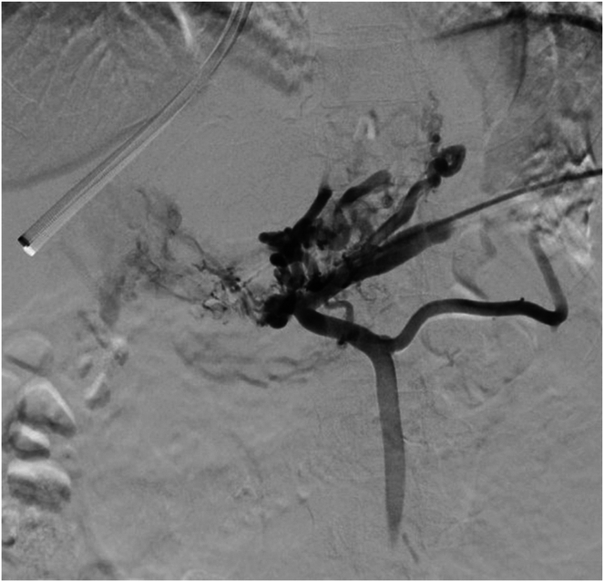 Portal Vein Recanalization Transjugular Intrahepatic Portosystemic Shunt for Noncirrhotic Chronic Portal Vein Thrombosis Leading to Successful Pregnancy: Case Report