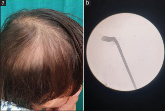 Loose Anagen Hair Syndrome in an Indian Child with Trichoscopic Features.