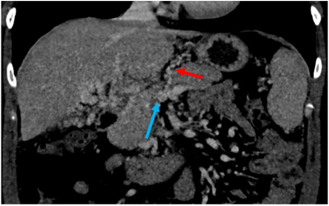 Portal Vein Recanalization Transjugular Intrahepatic Portosystemic Shunt for Noncirrhotic Chronic Portal Vein Thrombosis Leading to Successful Pregnancy: Case Report
