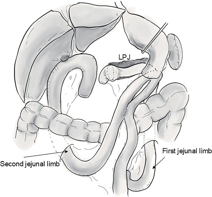 Longitudinal Pancreatojejunostomy for Pancreaticodigestive Reconstruction in the Resection of Pancreatic Head Malignancy with Chronic Pancreatitis: A Case Report.