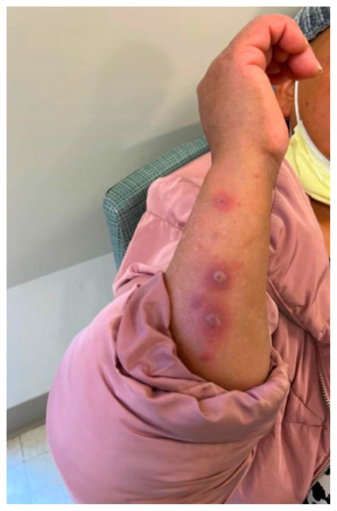 A Case Report on an Elusive Incident of Erythema Multiforme.
