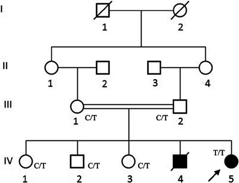 Identification of a pathogenic NHLRC1 variant in a consanguineous Pakistani family affected with severe and rapidly progressive Lafora disease.