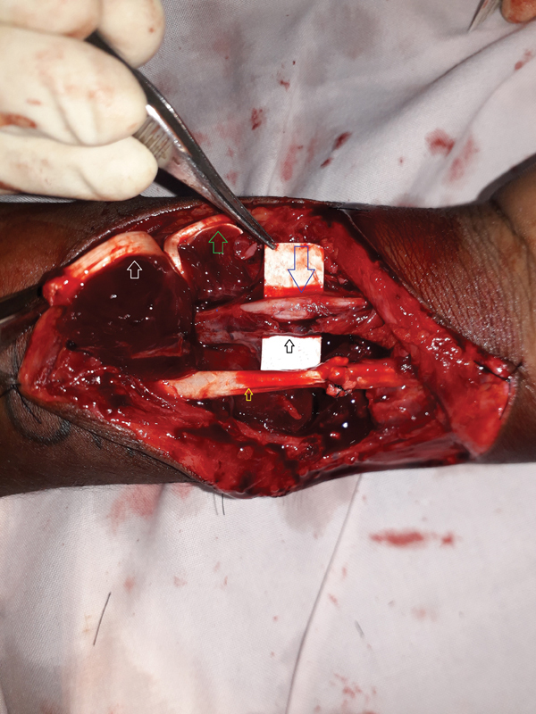 Incidental Finding of an Injured Anomalous Artery in the Forearm: To Repair or Not.