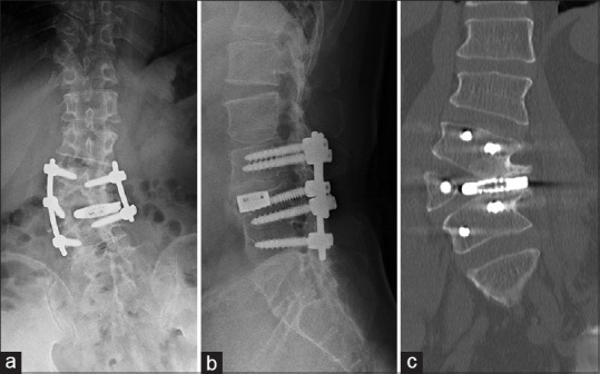 Oblique lateral interbody fusion with O-arm navigation for lumbar hemivertebra in an adult: A technical case report.