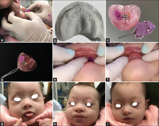 Orofacial Proprioceptive Stimulation Therapy with a Palatal Memory Plate in a Baby with Down Syndrome - 2-year Follow-up Case Report.