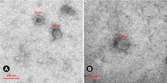 Extracellular vesicle-associated epidermal growth factor receptor as a potential liquid biopsy biomarker in lung adenocarcinoma: a case-control study.