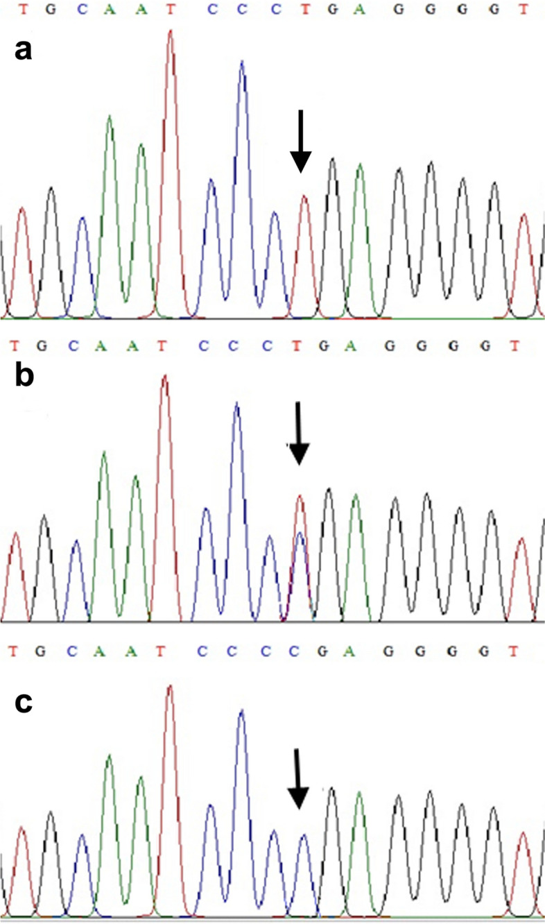 Identification of a pathogenic NHLRC1 variant in a consanguineous Pakistani family affected with severe and rapidly progressive Lafora disease.