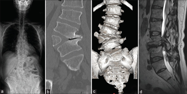 Oblique lateral interbody fusion with O-arm navigation for lumbar hemivertebra in an adult: A technical case report.