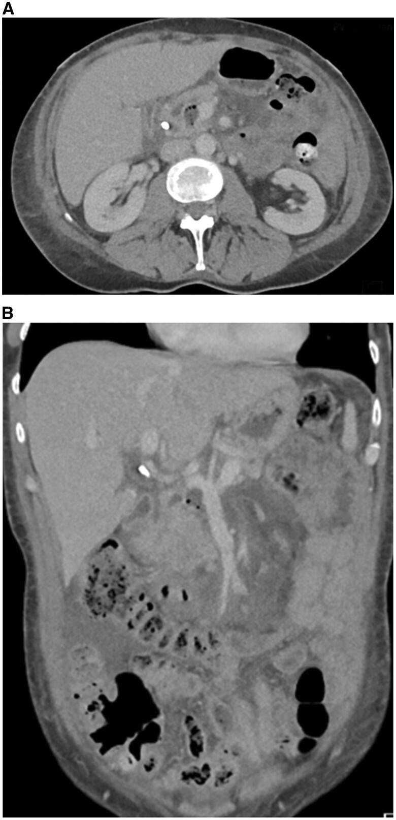 Rare complications of ERCP-pancreatitis, panniculitis, and polyarthritis syndromeand multifocal osteomyelitis.