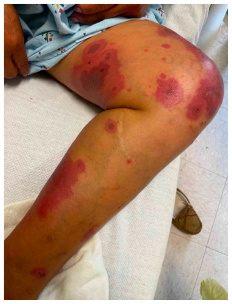 A Case Report on an Elusive Incident of Erythema Multiforme.