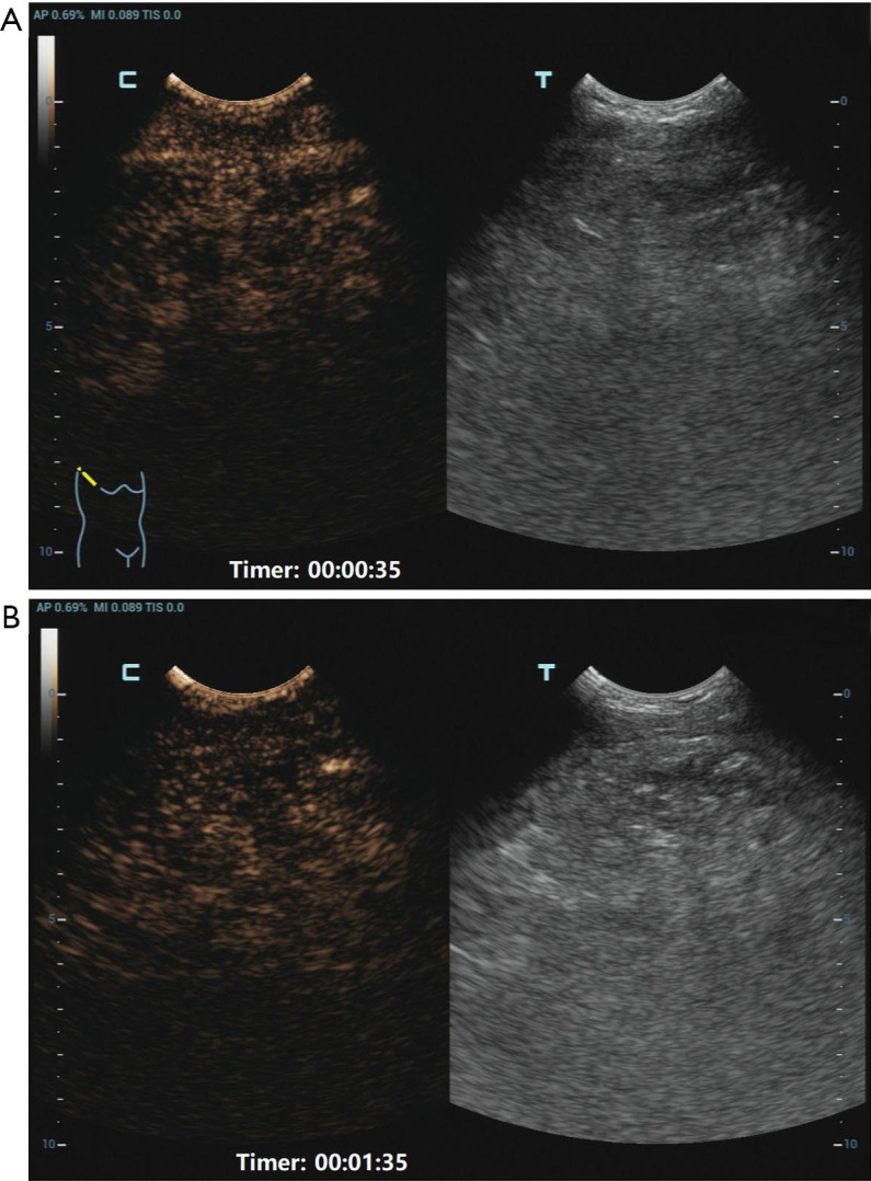 Giant thymolipoma in a 16-year-old girl with multimodal diagnostic approach and surgical management: a case report.