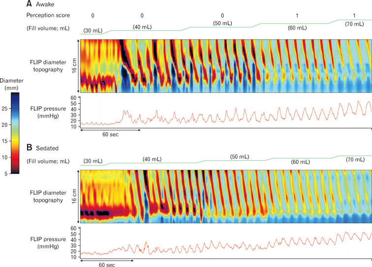 The Esophageal Response to Distension on Functional Lumen Imaging Probe Panometry Is Minimally Changed by Conscious Sedation in Healthy Asymptomatic Subjects.