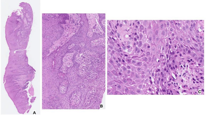 Correction: Oral mucosal changes caused by nicotine pouches: case series.