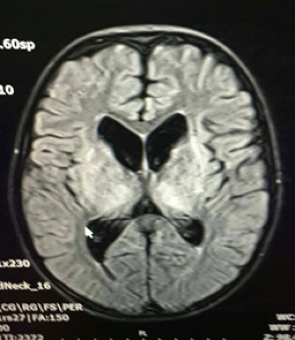 Acute Encephalopathy and Refractory Hypokalemia in a 12-Year-Old Boy.
