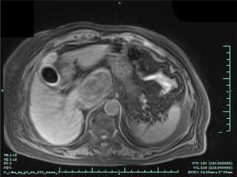EUS-guided drainage of multidrug-resistant enterococcal caudate lobe abscess inaccessible with percutaneous approach (with video).
