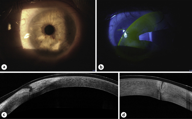 Management of Diathermy-Induced Corneal Burn following Upper Eyelid Blepharoplasty with Multilayer Amniotic Membrane Transplantation: A Case Report and Review of the Literature.