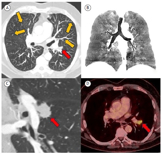 Diffuse idiopathic pulmonary neuroendocrine cell hyperplasia in a male patient associated with pulmonary adenocarcinoma.