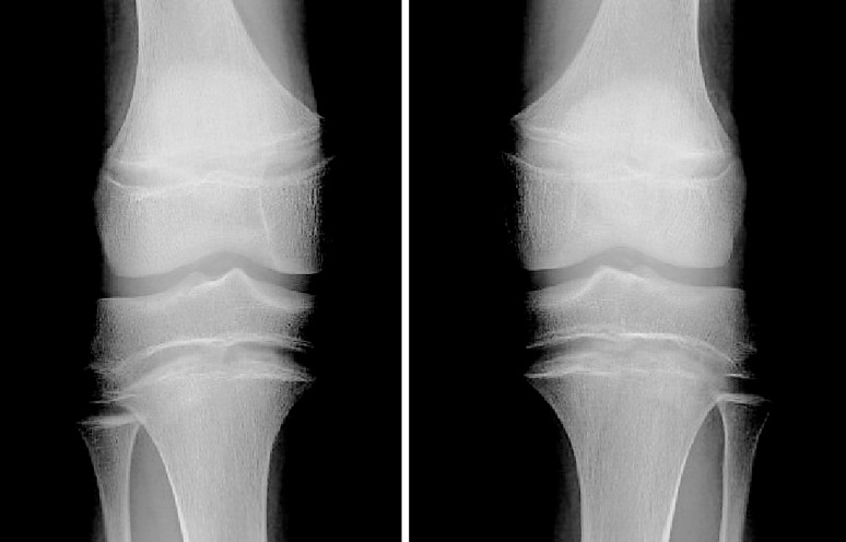 A Novel Pathogenic Variant in Fibroblast Growth Factor 23 outside the Furin-Recognizing RXXR Motif in an Autosomal Dominant Hypophosphatemic Rickets Patient.