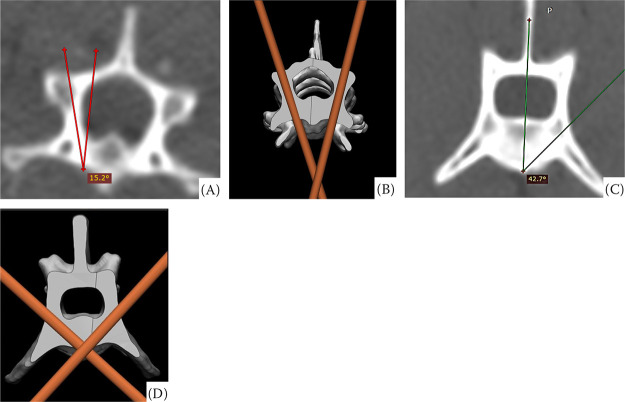 Assessment of the accuracy of patient-specific drilling guides for cervical (C5-C6) and lumbar (L4-L5) vertebrae in cats.