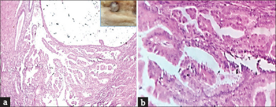 Silent Intruders: A Case Report of Concurrent Atypical Endometrial Polyp with Cervical Intraepithelial Neoplasia.
