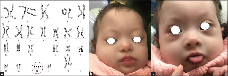 Orofacial Proprioceptive Stimulation Therapy with a Palatal Memory Plate in a Baby with Down Syndrome - 2-year Follow-up Case Report.