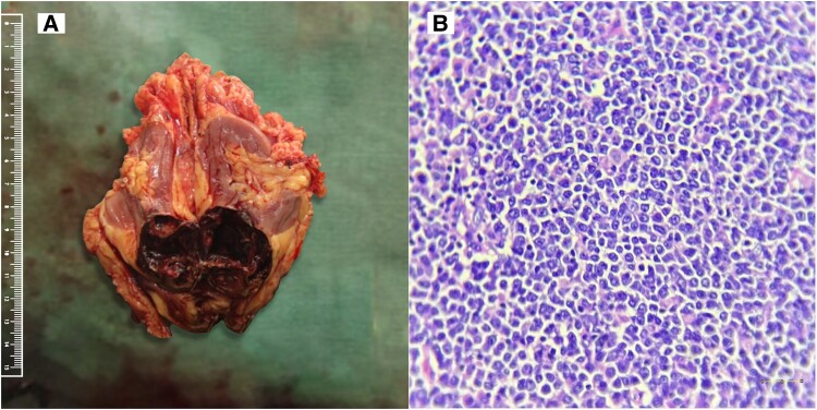 An Interesting Case of Vitamin D-Mediated Severe Hypercalcemia in a Patient With Renal Mass.