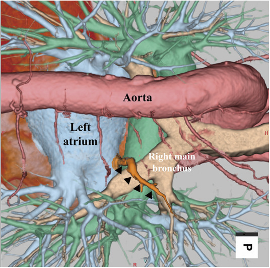 Intraoperative Fluorescent Imaging with Indocyanine Green during Thoracoscopic Esophagectomy with Subcarinal Lymph Node Dissection for Esophageal Cancer with a Right Superior Pulmonary Vein Anomaly: A Case Report and Literature Review.